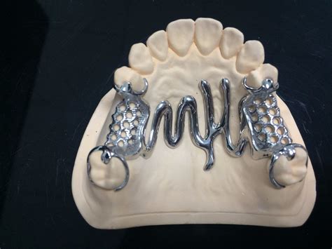 metals used to fabricate removable partial denture frameworks|removable partial denture cast metal.